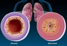 Astım ve alerjik bronşit aynı hastalık mıdır? 